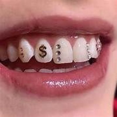 Ttine, bijoux dentaires, blanchiment... : derrire ces tendances virales, des risques bien rels